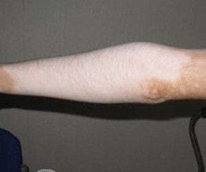 肢端型白癜风对患者有哪些危害