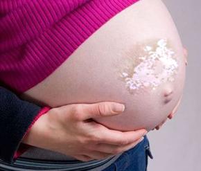 孕妇白癜风治疗要注意哪些